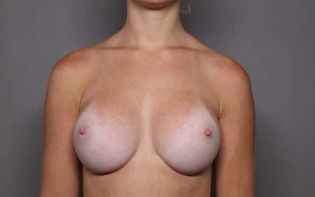 Breast Augmentation Frontal View 6 Months Post Op