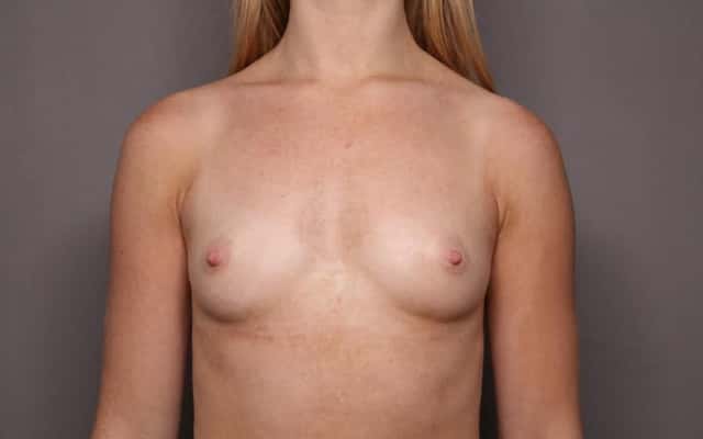 Breast Augmentation Frontal View Before
