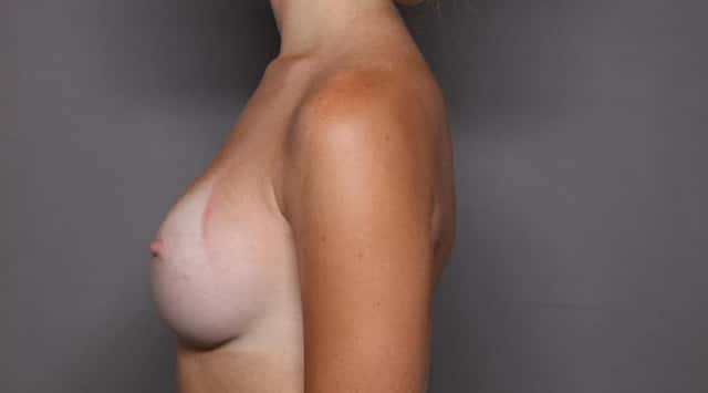 Breast Augmentation Left Side View 6 Months Post Op