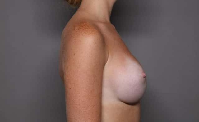 Breast Augmentation Right Side View 6 Months Post Op