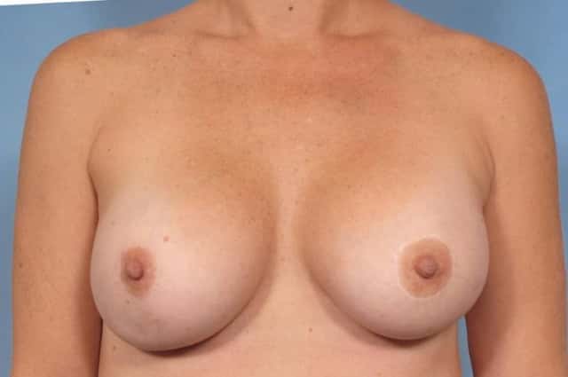 Breast Augmentation Before & After Case 47 after
