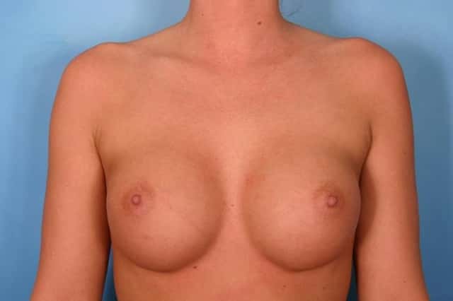 Breast Augmentation Before & After Case 68 after
