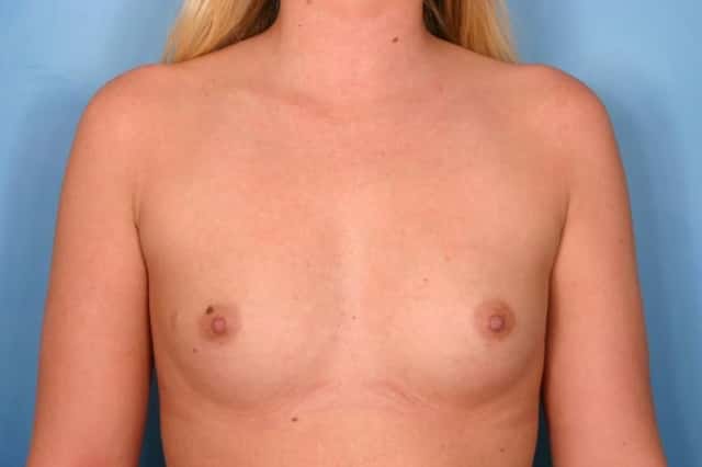 Breast Augmentation Before & After Case 68 before