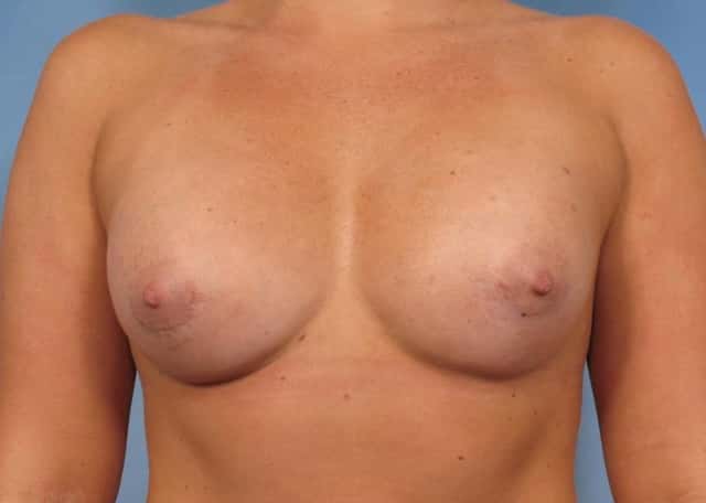 Breast Augmentation Before & After Case 88 after