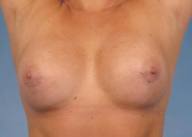 Breast Augmentation Before & After Case 88 after