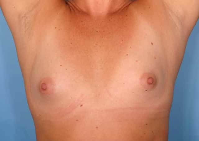 Breast Augmentation Before & After Case 88 before
