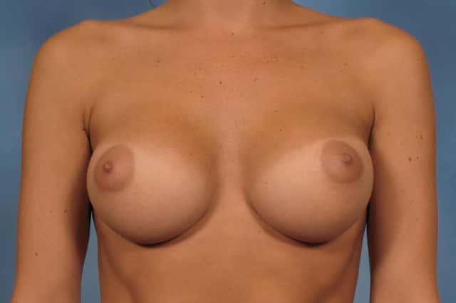 Breast Augmentation Before & After Case 95 after
