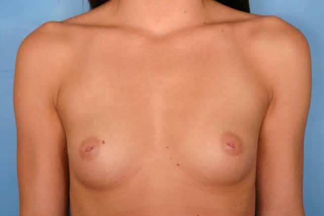 Breast Augmentation Before & After Case 98 before