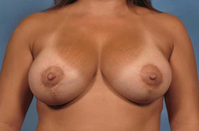 Breast Augmentation with Lift Before & After Case 118 after