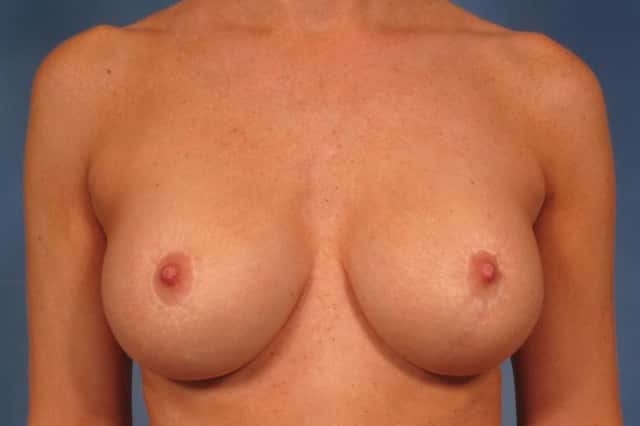 Breast Augmentation with Lift Before & After Case 135 after