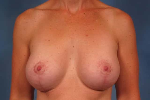 Breast Augmentation with Lift Before & After Case 203 after