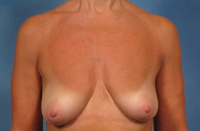 Breast Augmentation with Lift Before & After Case 252 before