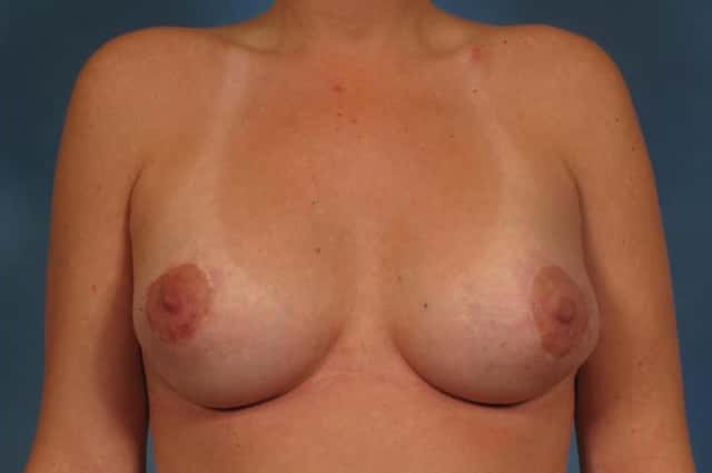 Breast Augmentation with Lift Before & After Case 255 after