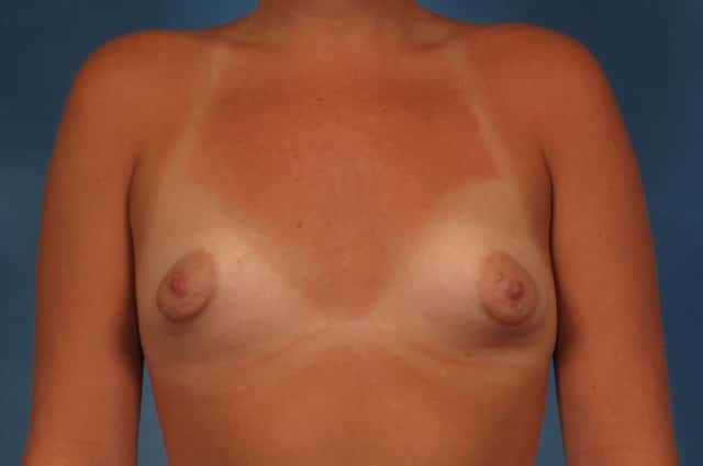 Breast Augmentation with Lift Before & After Case 255 before