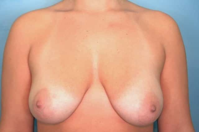 Breast Augmentation with Lift Before & After Case 56 before