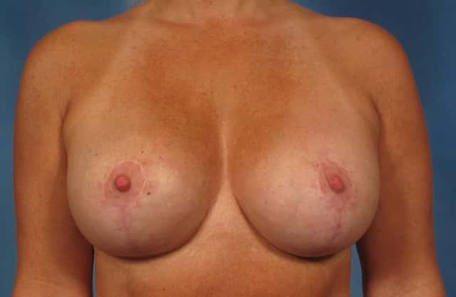 Breast Implant Exchange/Revision Before & After Case 261 after