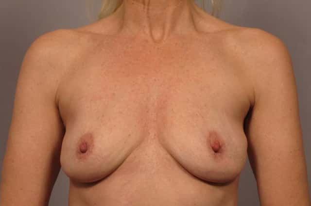 Breast Implant Removal for Patient Feeling symptoms of Breast Implant Illness after