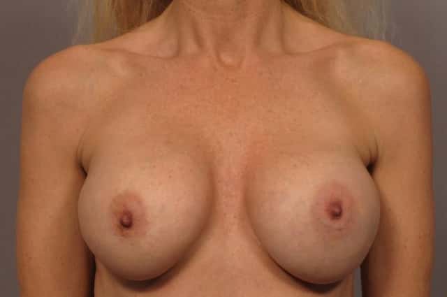 Breast Implant Removal for Patient Feeling symptoms of Breast Implant Illness before