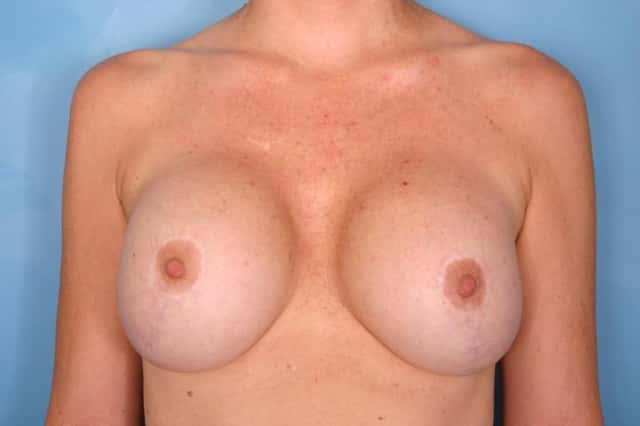 Breast Implant Removal for Patient Unhappy with the large size of the saline implants before