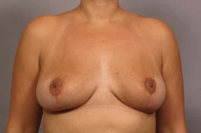 Breast Implant Removal and Lift for Patient who wants to be smaller and perkier after