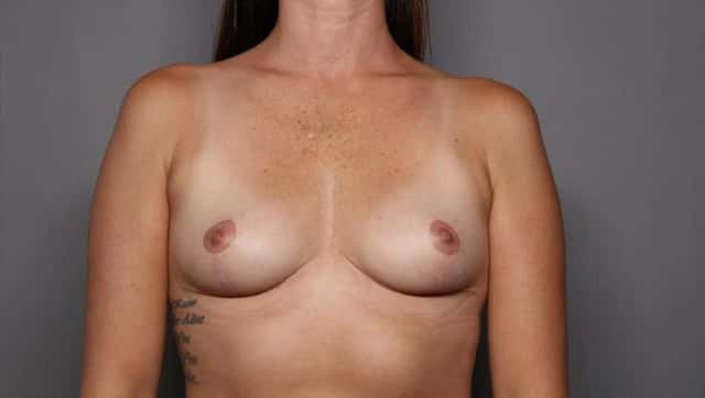 Breast Implant Removal and Breast Lift Frontal View 9 Months Post Op