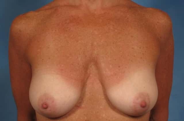 Breast Lift Before & After Case 199 before