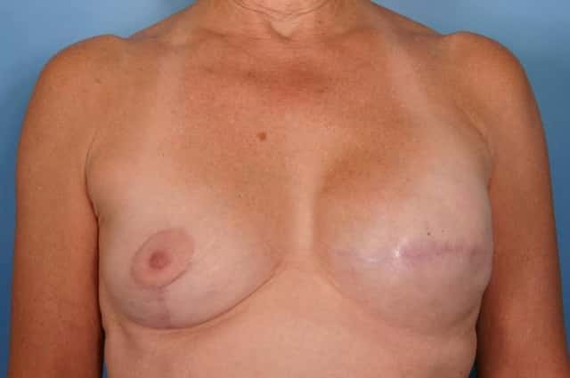 Breast Lift Before & After Case 34 after