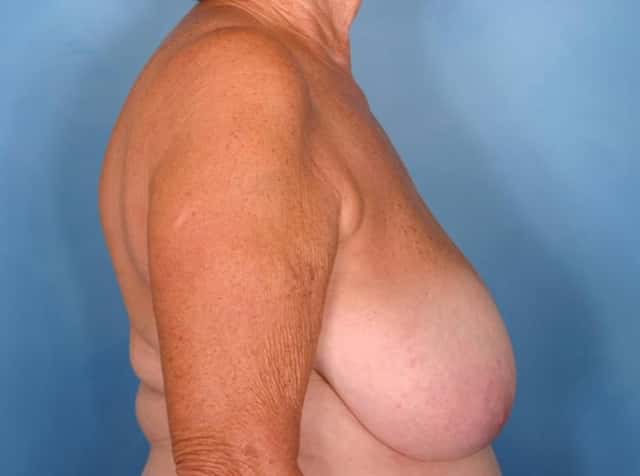 Breast Reduction Before & After Case 50 before