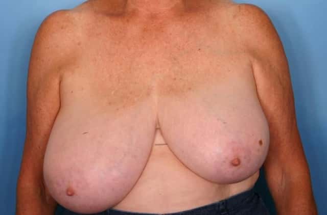 Breast Reduction Before & After Case 59 before