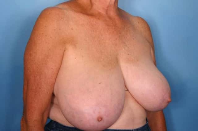 Breast Reduction Before & After Case 59 before
