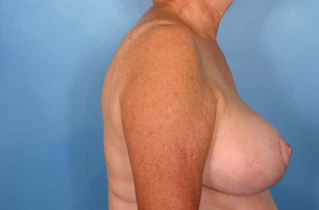 Breast Reduction Before & After Case 59 after
