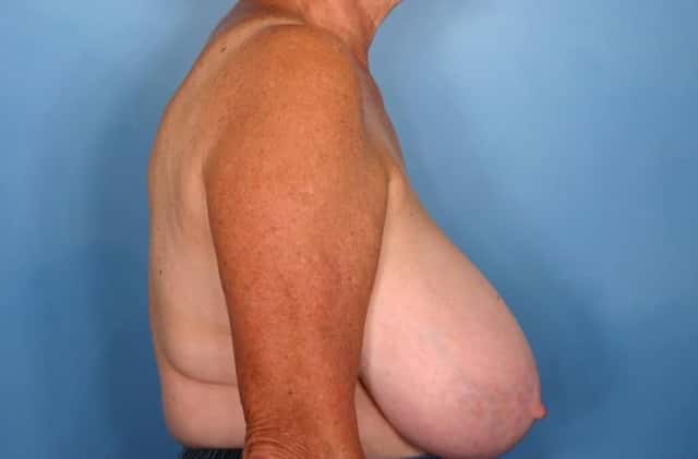 Breast Reduction Before & After Case 59 before