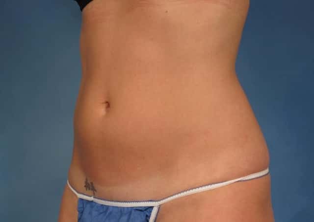 CoolSculpting® Elite Before & After Case 167 before