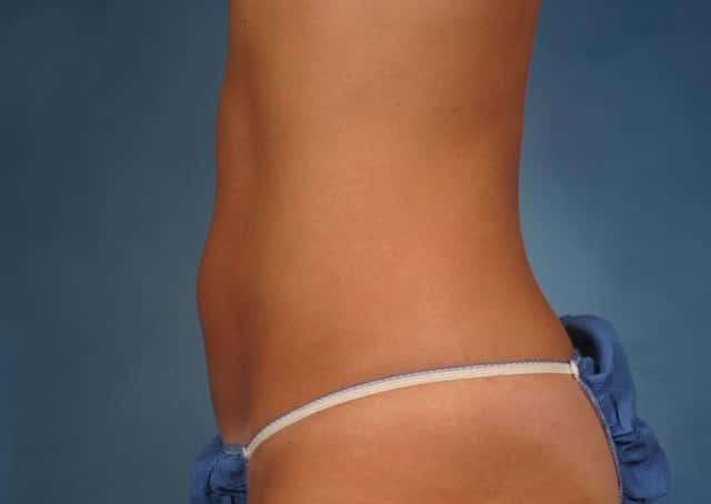 CoolSculpting® Elite Before & After Case 167 after