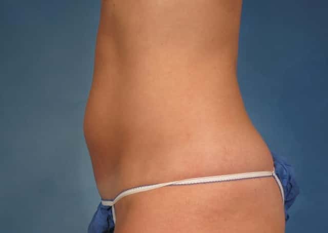 CoolSculpting® Elite Before & After Case 167 before