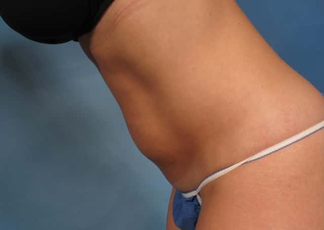 CoolSculpting® Elite Before & After Case 167 before