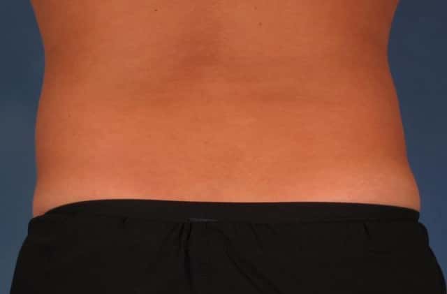 CoolSculpting® Elite Before & After Case 209 after