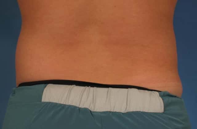 CoolSculpting® Elite Before & After Case 209 before