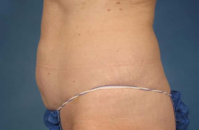 CoolSculpting® Elite Before & After Case 213 after