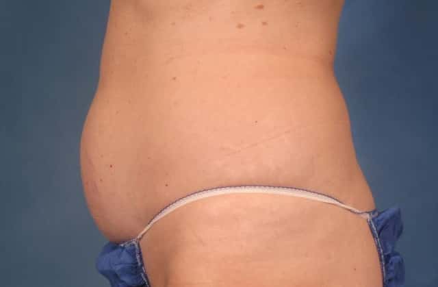 CoolSculpting® Elite Before & After Case 213 before