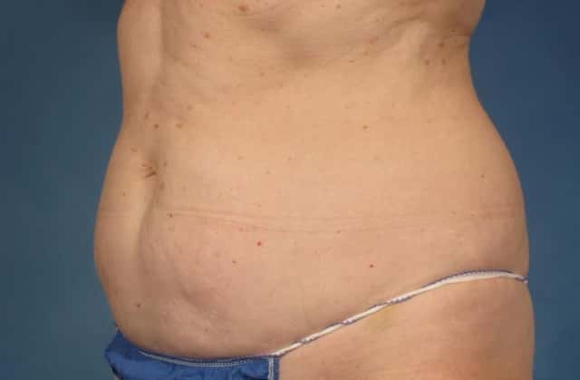 CoolSculpting® Elite Before & After Case 213 after