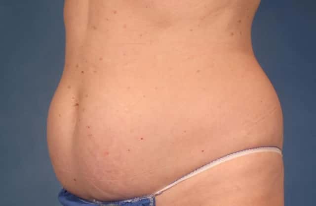 CoolSculpting® Elite Before & After Case 213 before