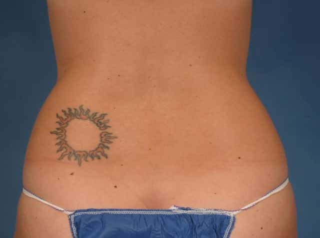 CoolSculpting® Elite Before & After Case 223 after