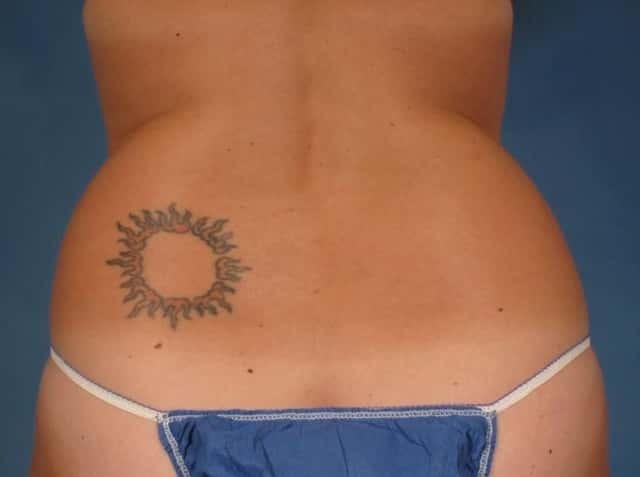 CoolSculpting® Elite Before & After Case 223 before