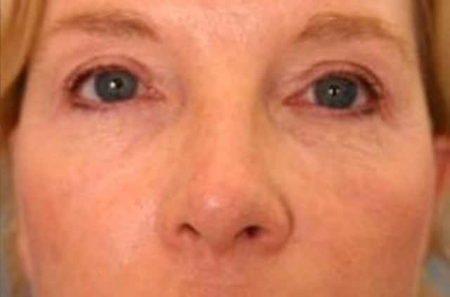 Eyelid Lift (Blepharoplasty) Before & After Case 19 after