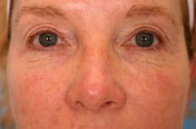 Eyelid Lift (Blepharoplasty) Before & After Case 19 before