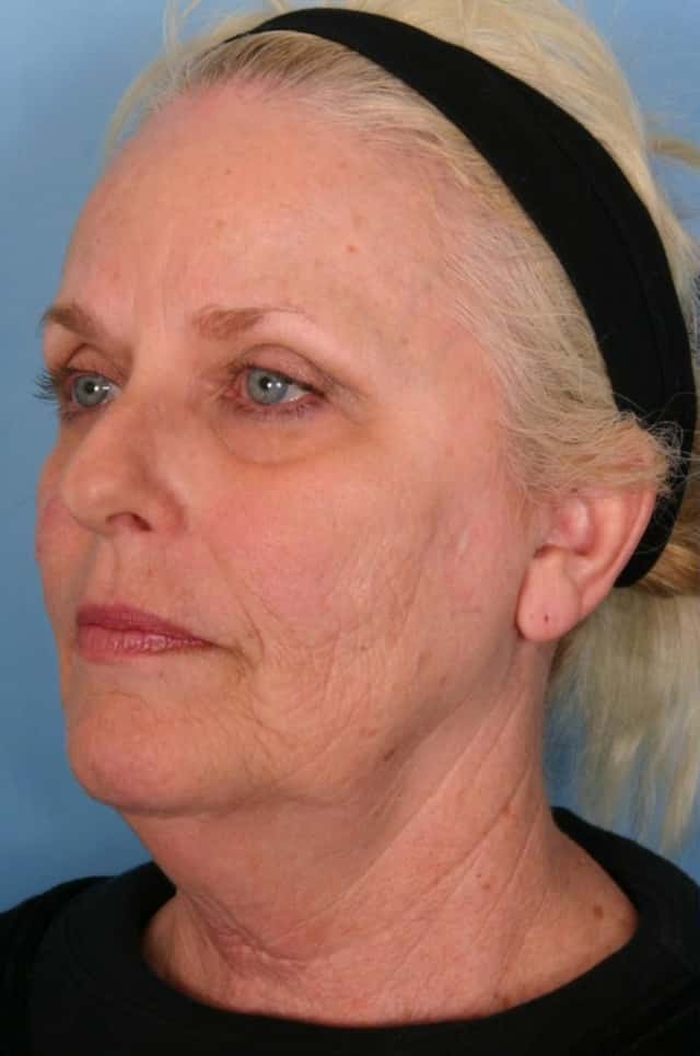 Facelift Before & After Case 10 before
