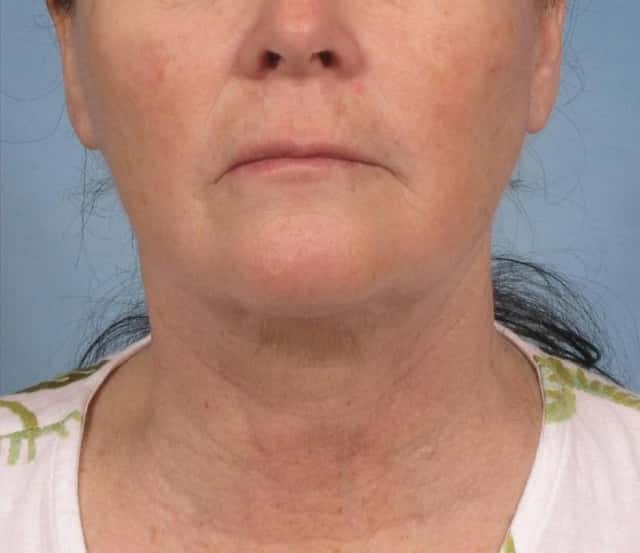 Facelift Before & After Case 109 after