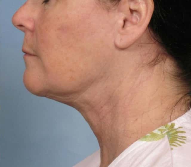 Facelift Before & After Case 109 after