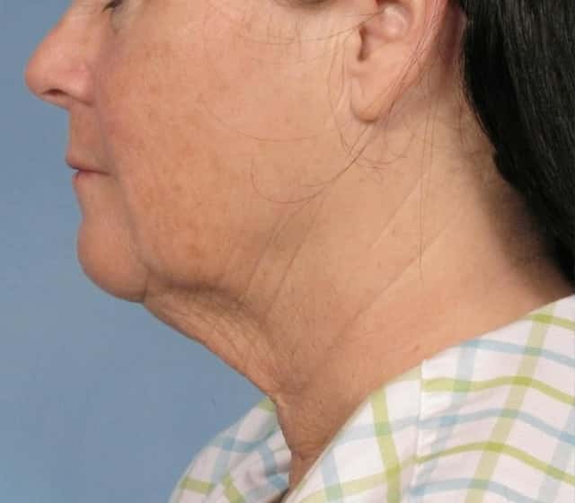 Facelift Before & After Case 109 before
